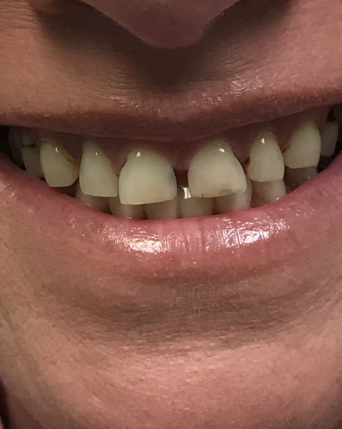 Before smile transformation