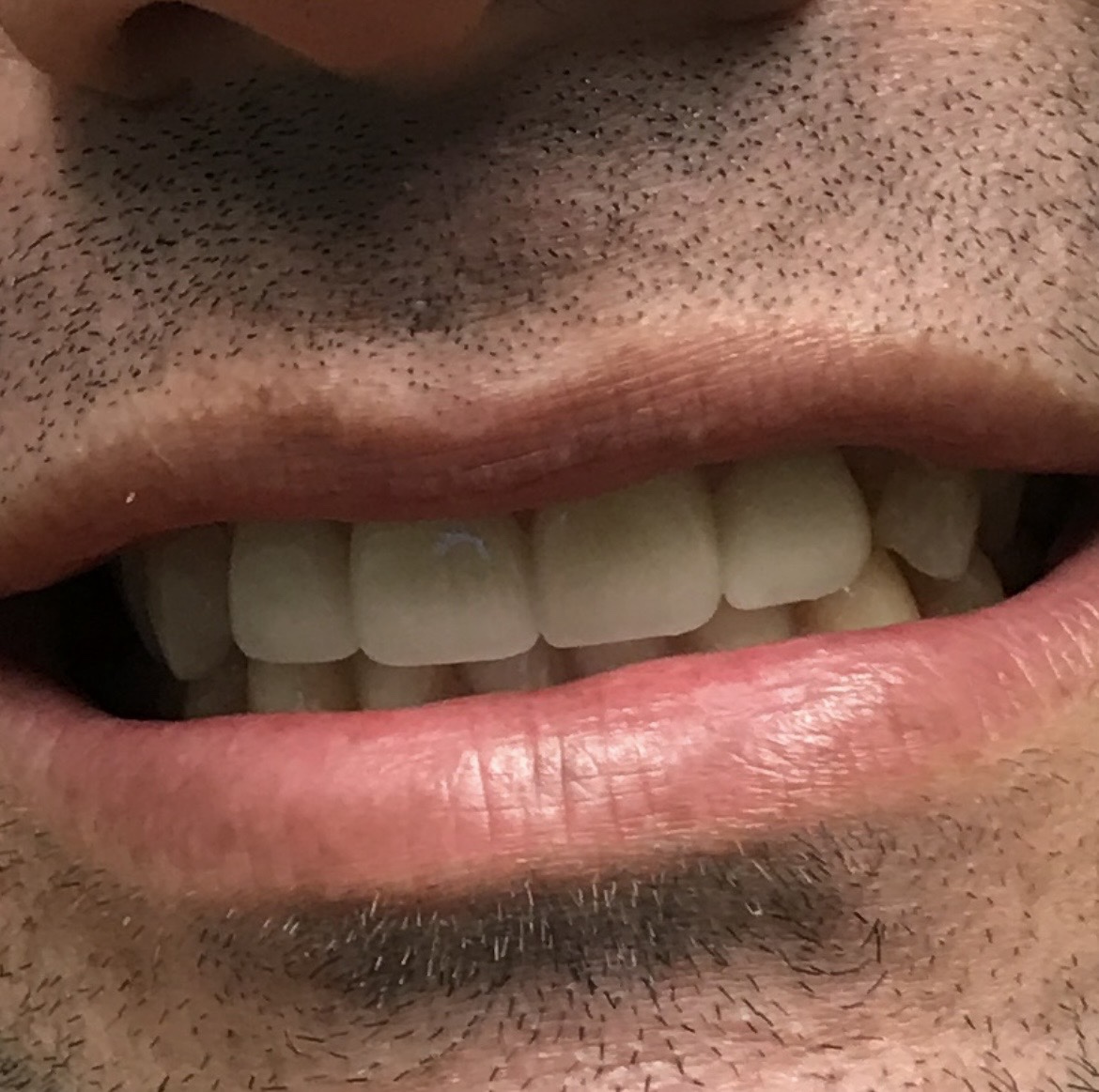 After case 1