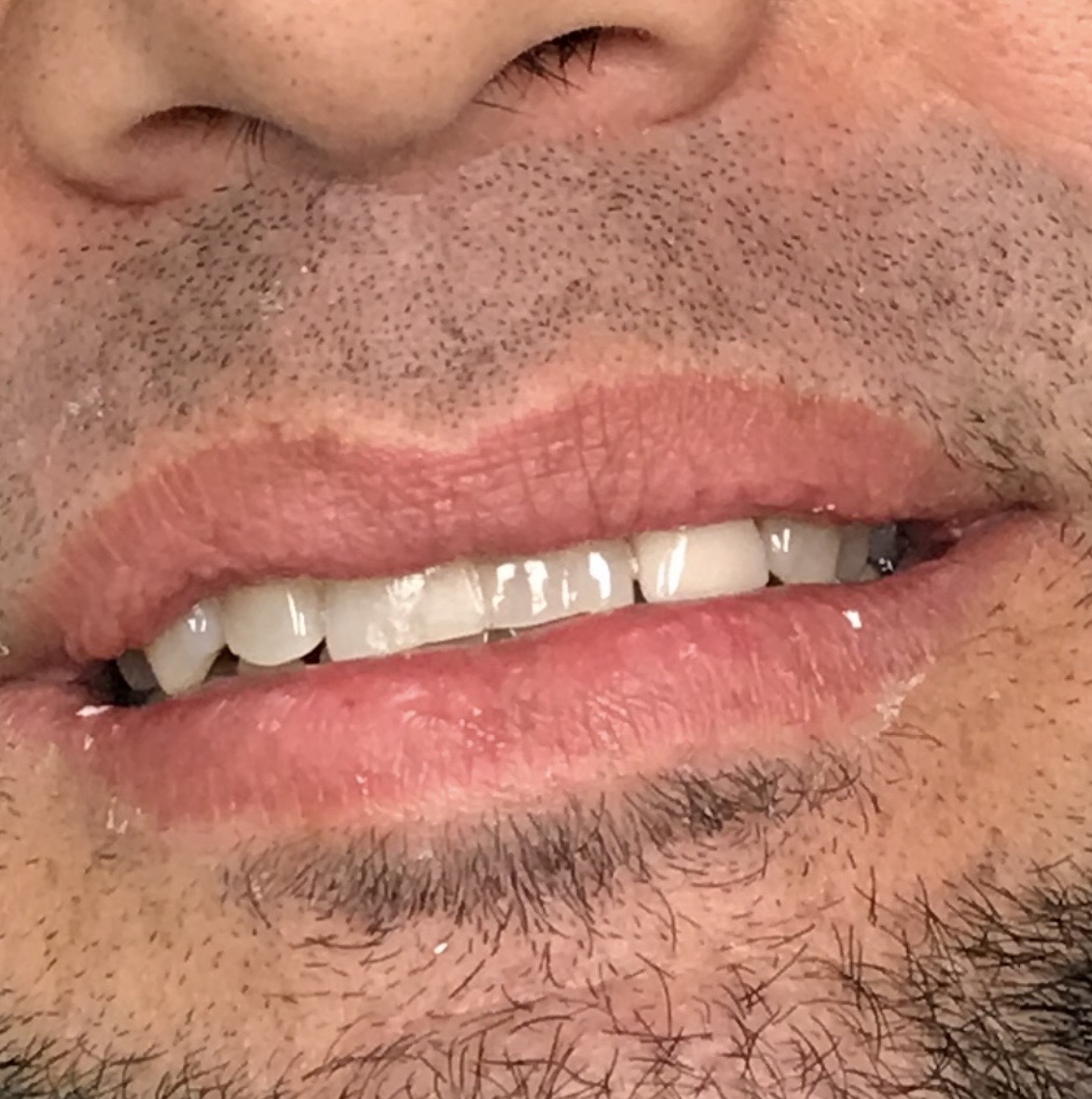 Before case 1